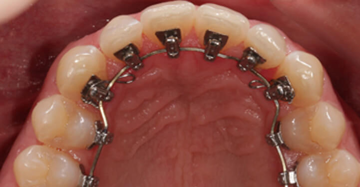 View of an orthodontic device with brackets and wires in the mouth.